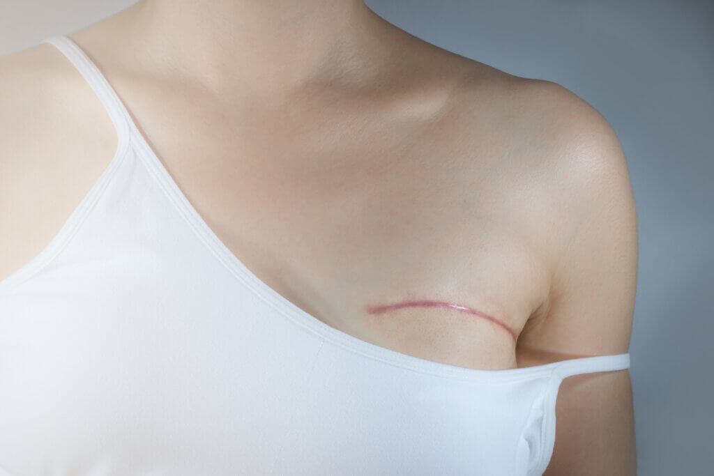 Breast cancer surgery scars